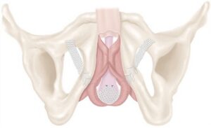 diagram of male anatomy with regards to bladder and incontinence