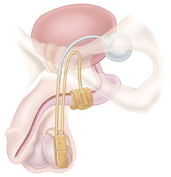 diagram of male anatomy with regards to bladder and incontinence